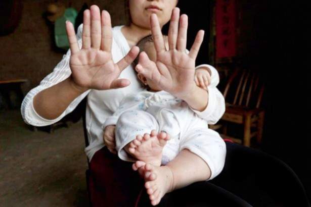 بالصور: طفل يولد بـ31 إصبعاً 