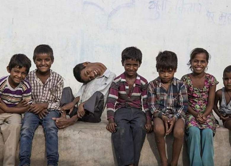 بالصور: حالة نادرة جدّا.. رقبته معلّقة بـ180 درجة على جسده!