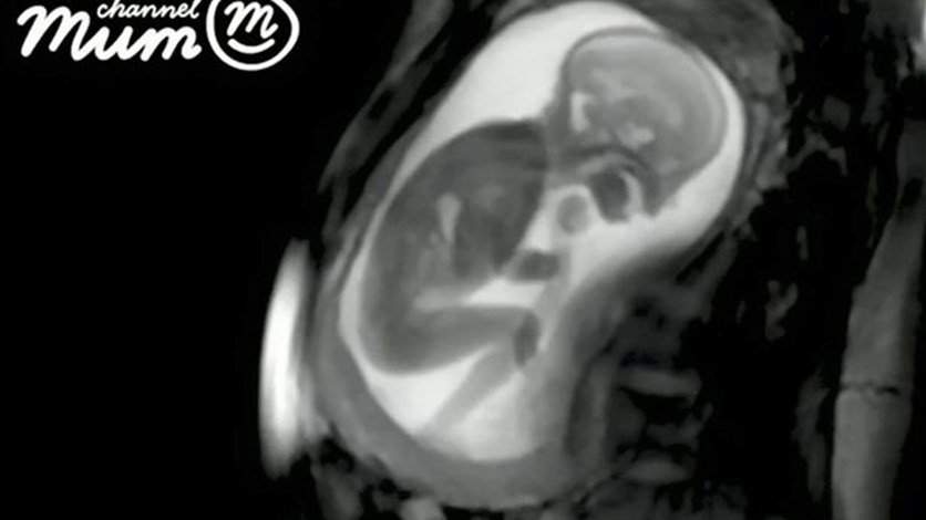 بالفيديو/ مشهد مذهل لجنين داخل رحم أمه بتقنية حديثة 