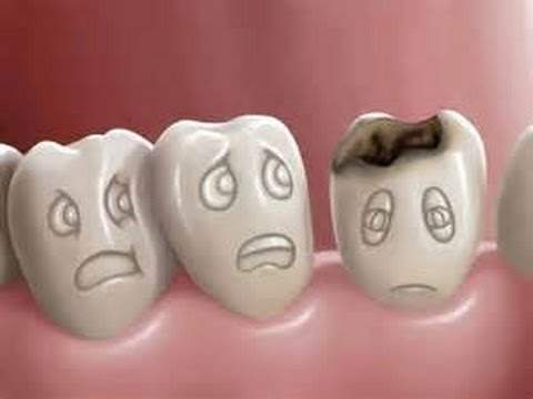 طريقة مذهلة لإزالة تسوس الأسنان نهائيًا بالمنزل