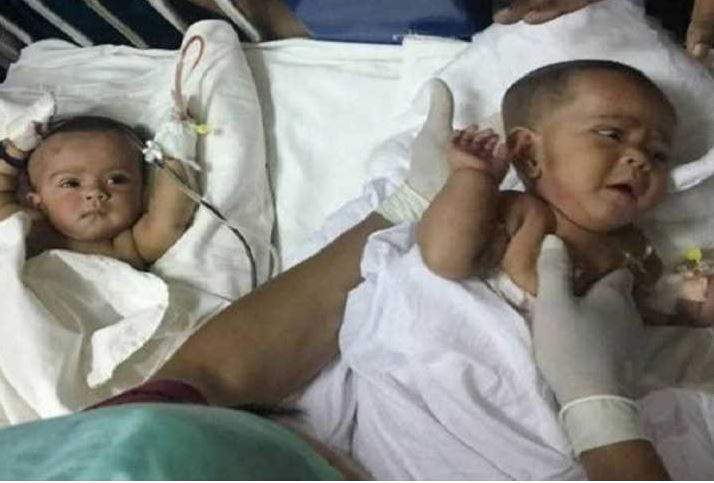 أول عملية ناجحة لفصل توأمين سياميين