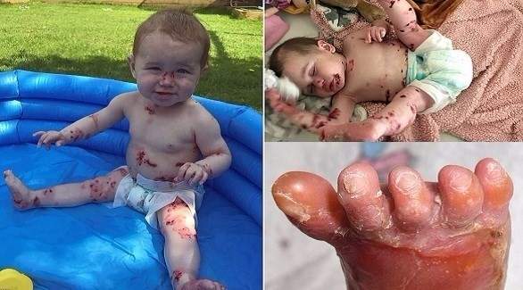 مرضٌ يفتكُ بطفلة.. ووالدتها محرومةٌ من احتضانها!