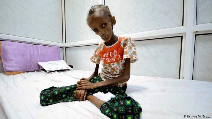 هكذا كان شكل سعيدة أحمد بغيلي قبل سنة. وفي مستشفى الثورة بمدينة الحديدة الساحلية كافحت المرأة الشابة ضد الموت من الجوع. وكان وزن البنت في الثامنة عشرة من عمرها آنذاك 11 كيلوغراما.