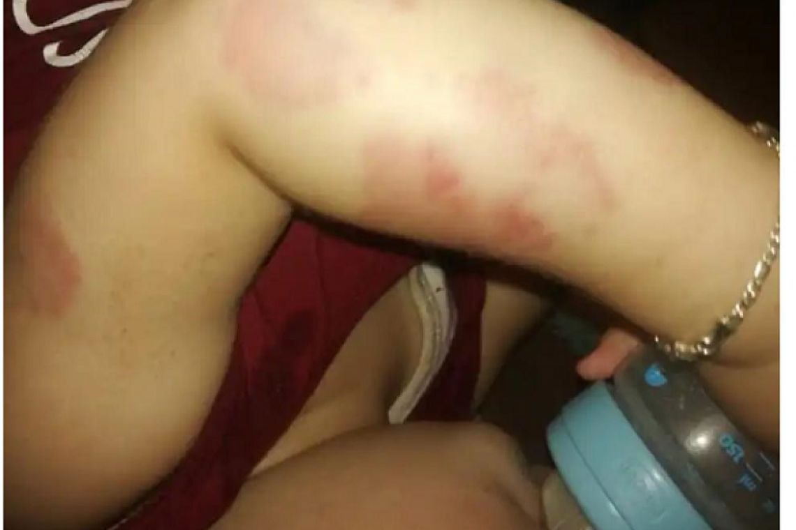 بالصورة/ طفل تعرض للتعنيف في إحدى الحضانات في طرابلس ومديرة الحضانة اتخذت التدابير اللازمة!