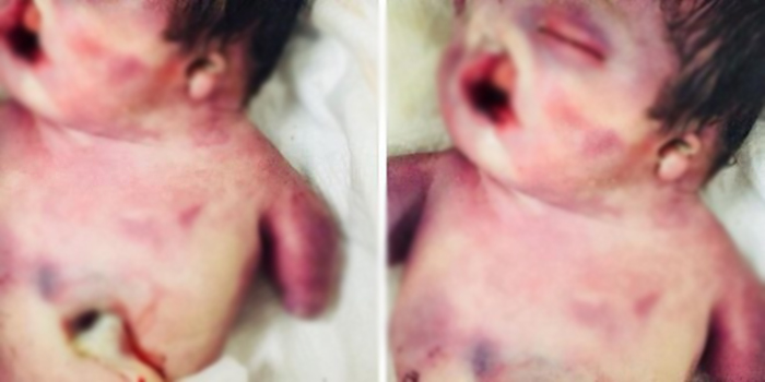 في حالة طبية غريبة ولادة طفل بلا أطراف في العراق...كان يشكو من ضمور في أطرافه وتشوهات في الوجه وتوفي 