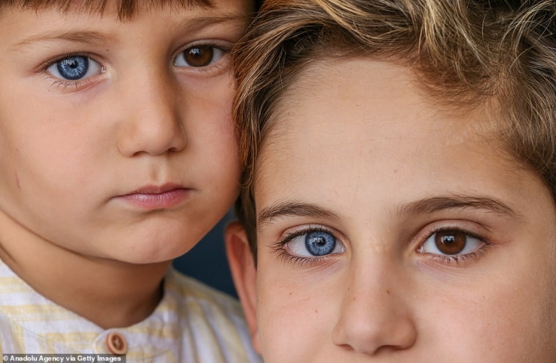 بالصور/ حالة نادرة...محمد وكريم شقيقان كلاهما ولدا بعين زرقاء وعين بنية اللون!