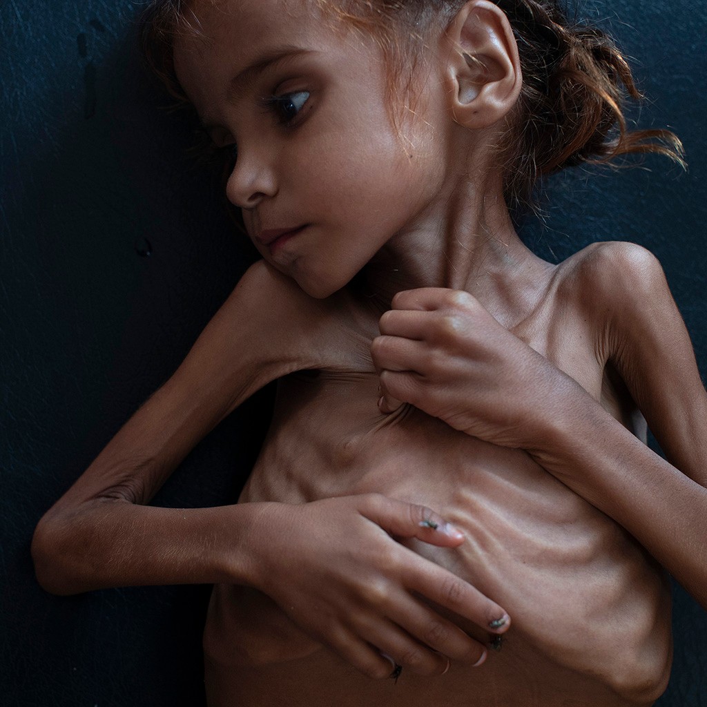 صورة طفلة يمنية نشرتها صحيفة وشاركها الآلاف... ولكن فيسبوك حذفها!