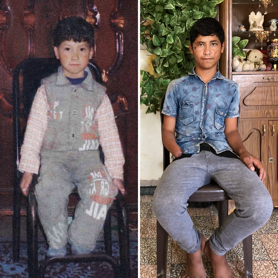 &quot;باسل&quot; الطفل السوري شارك في تحدي الـ10 سنوات...فقد بيته ويده اليمنى وتغير وجهه