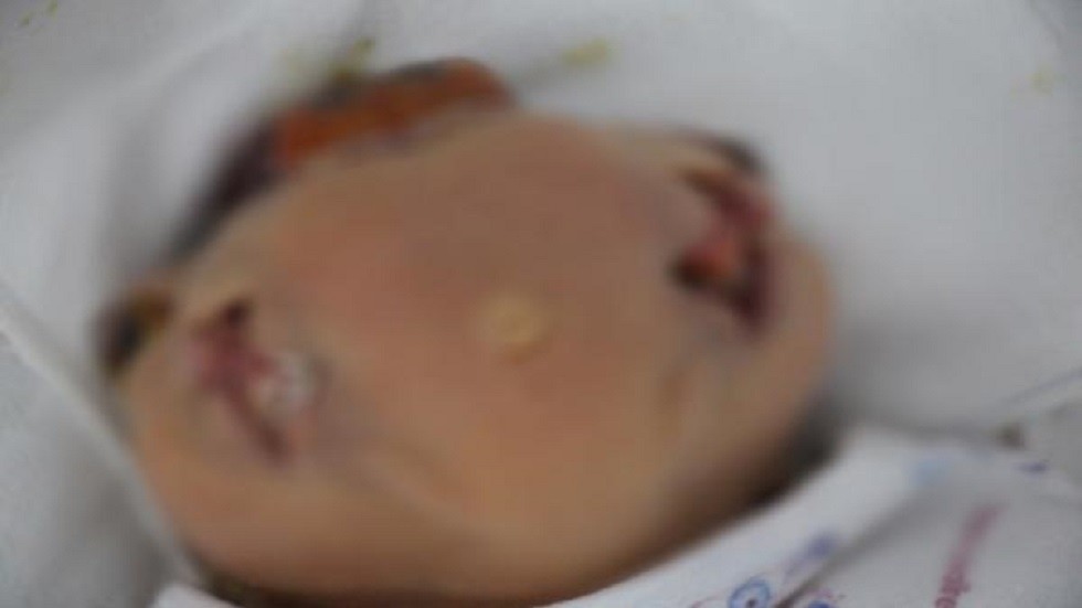 بالصورة/ ولادة طفل سوري بأربع عيون وفمين...حالة واحدة من بين كل مليون حالة ولادة!